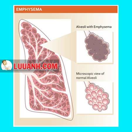 BỆNH PHỔI TẮC NGHẼN MẠN TÍNH (COPD)