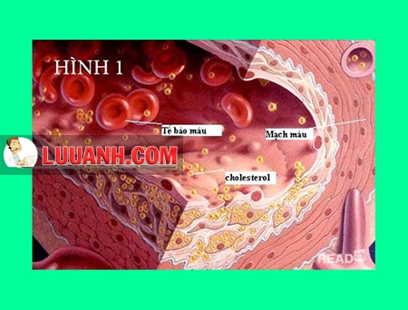 Rối loạn mỡ máu