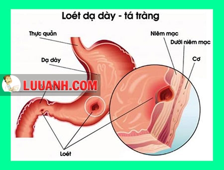 viêm dạ dày – tá tràng