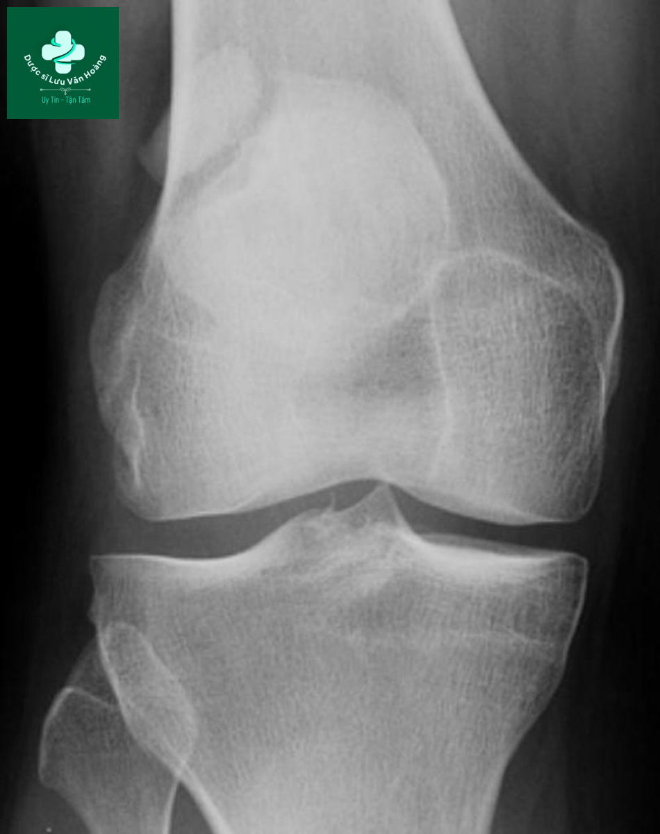 Bipartite patella 1