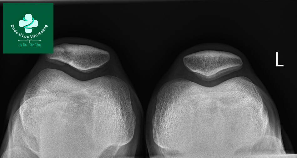 Bipartite patella 10