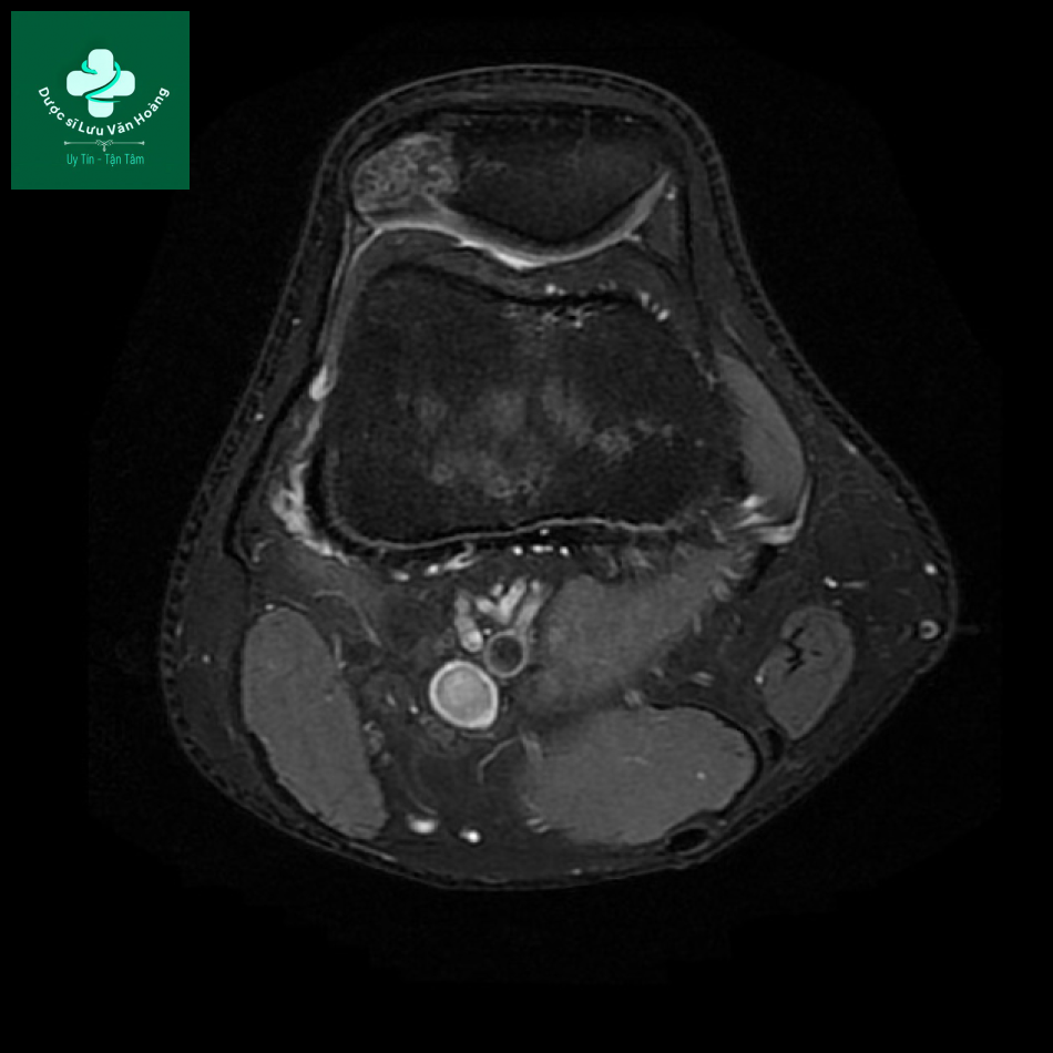Bipartite patella 11