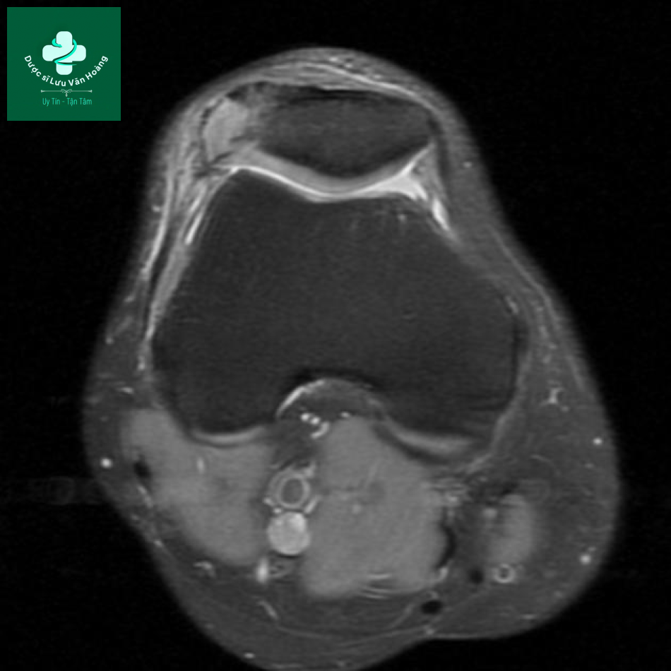Bipartite patella 12
