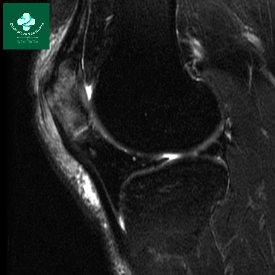 Bipartite patella 13