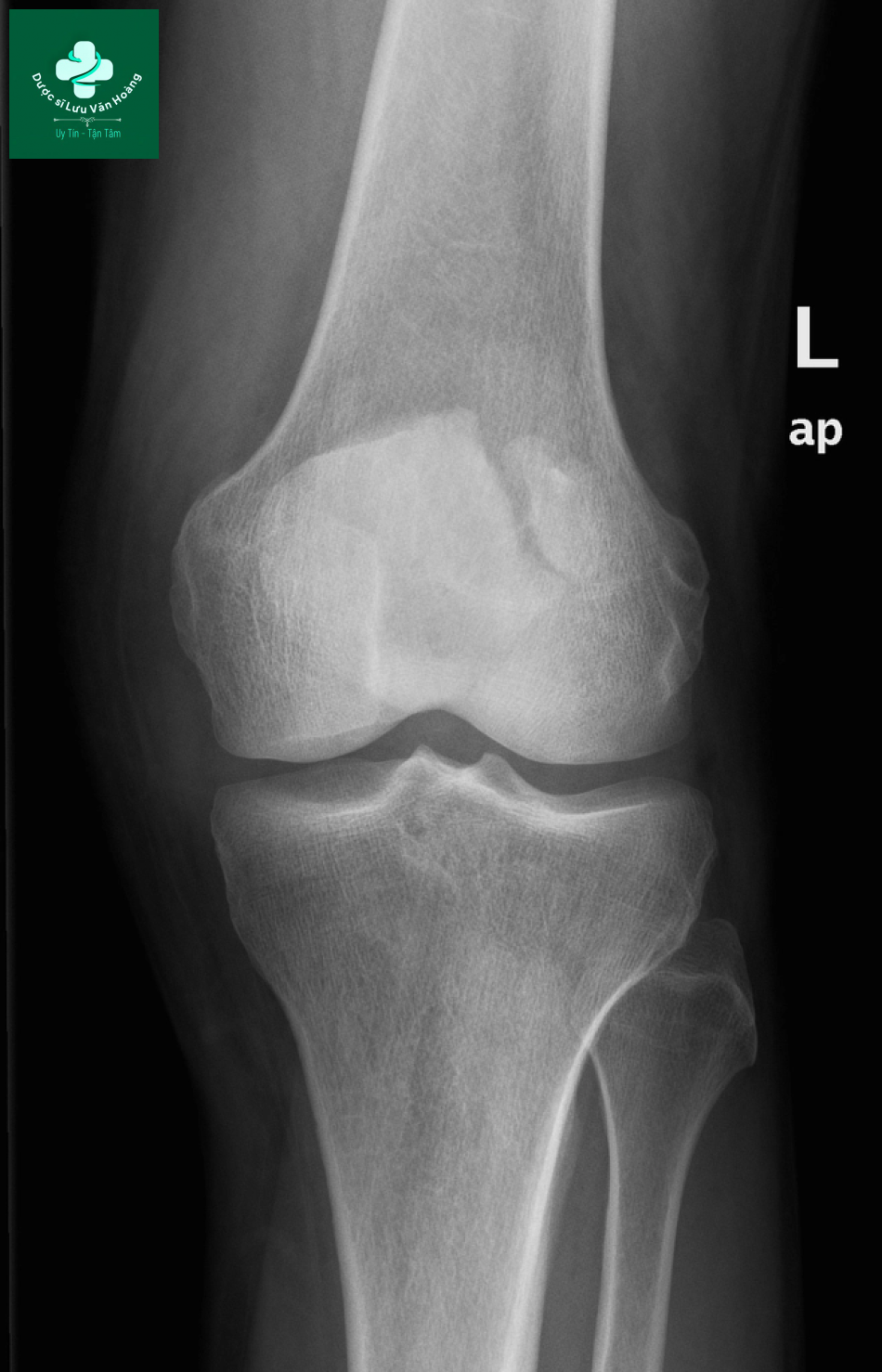 Bipartite patella 3