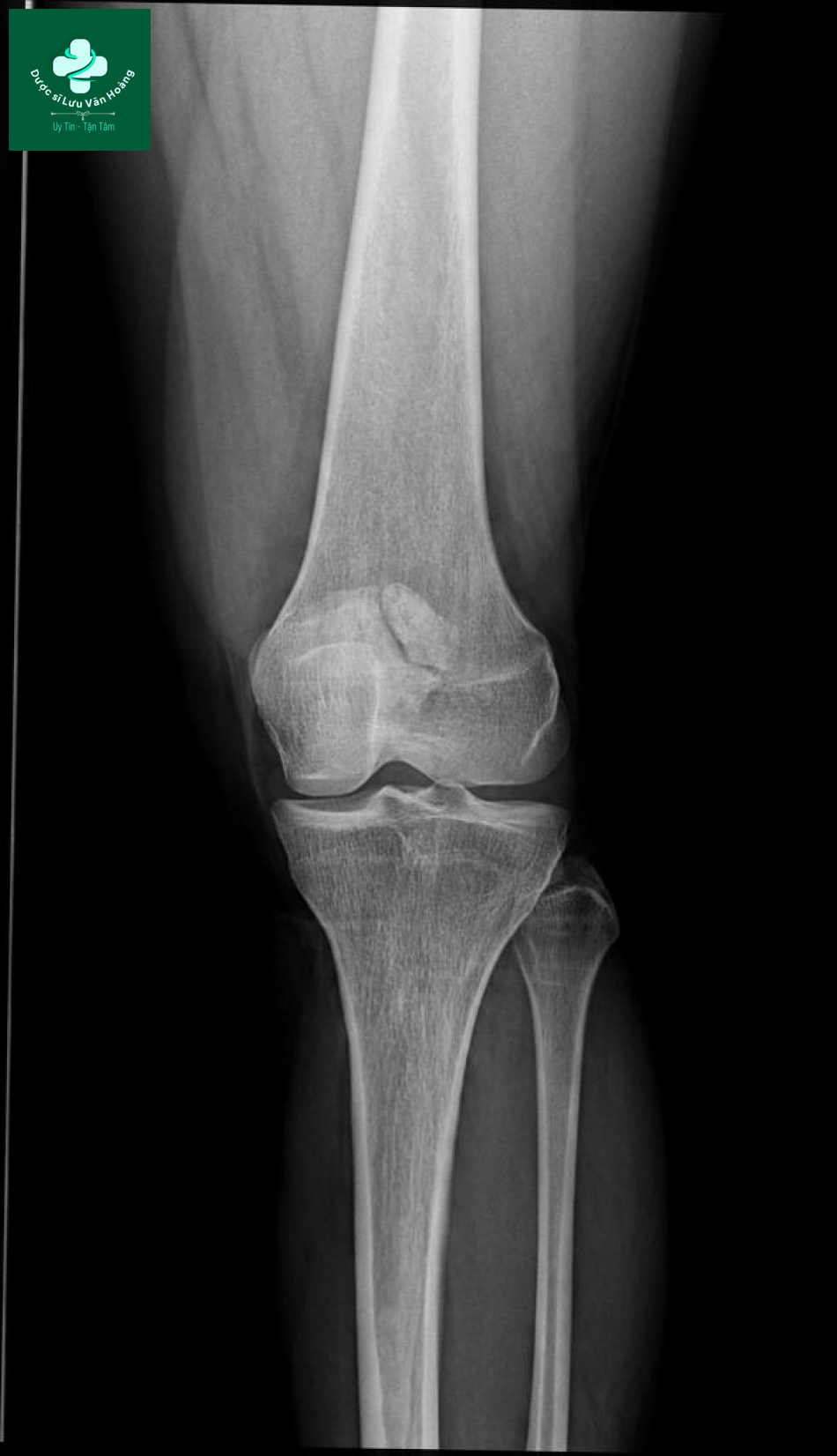 Bipartite patella 5