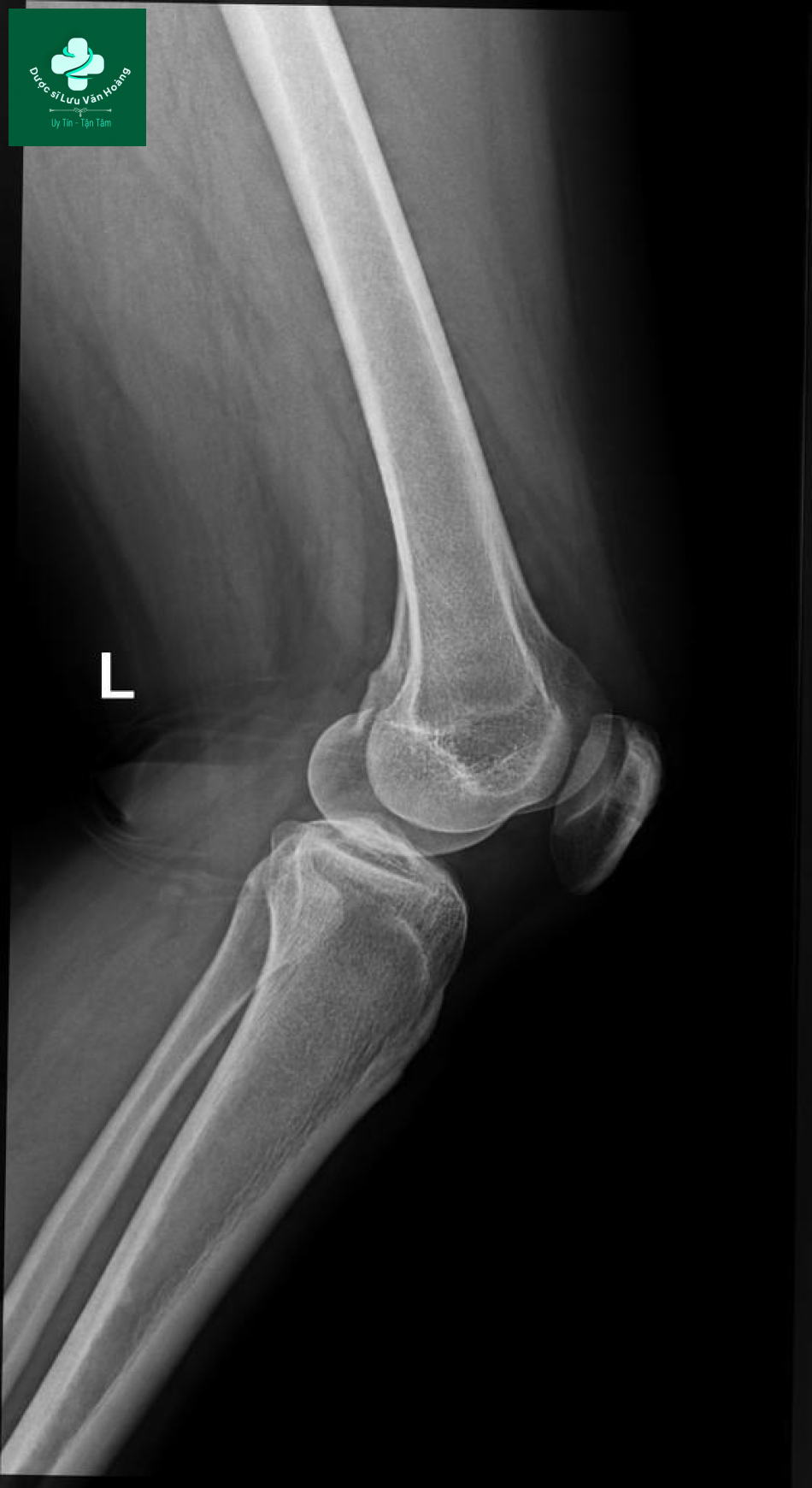 Bipartite patella 6