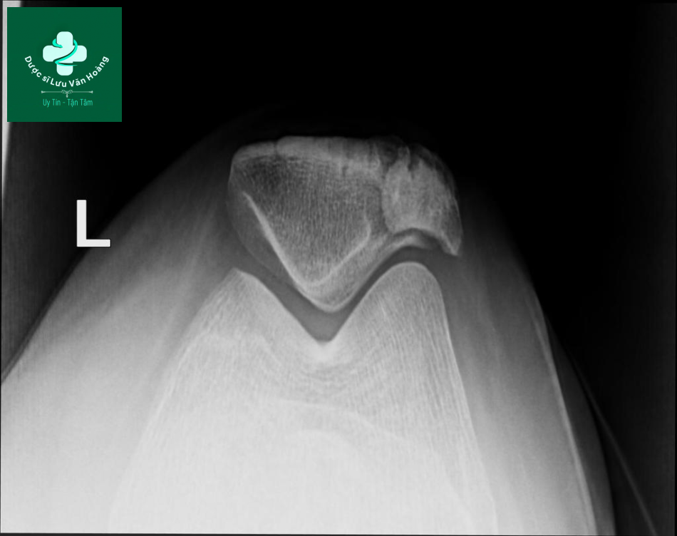 Bipartite patella 7