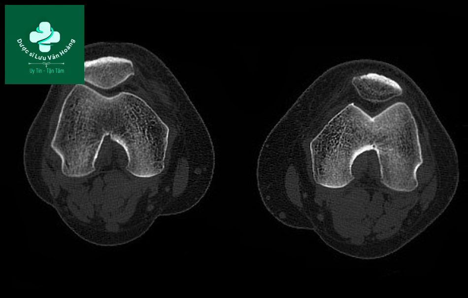Bipartite patella 8