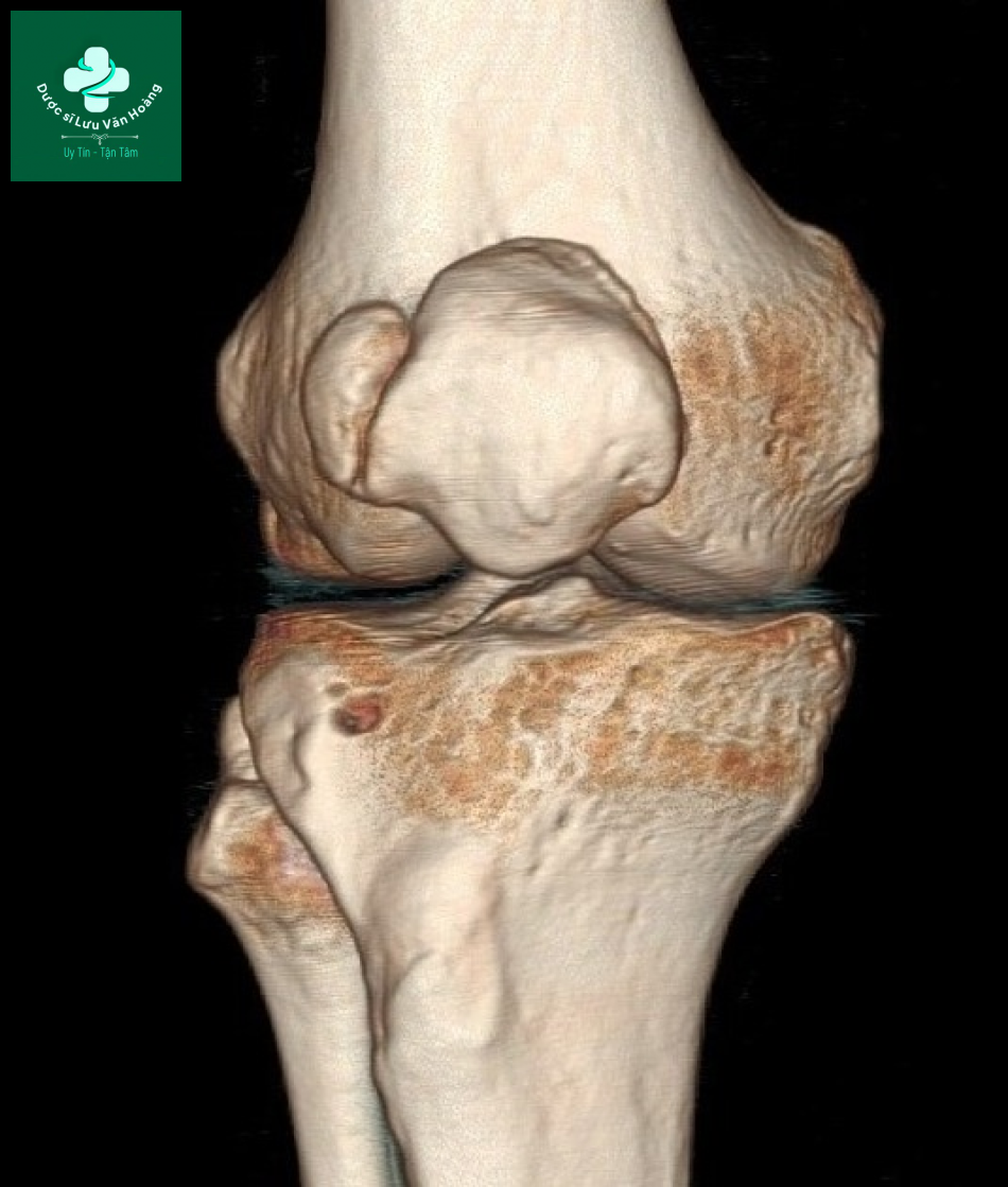 Bipartite patella 9