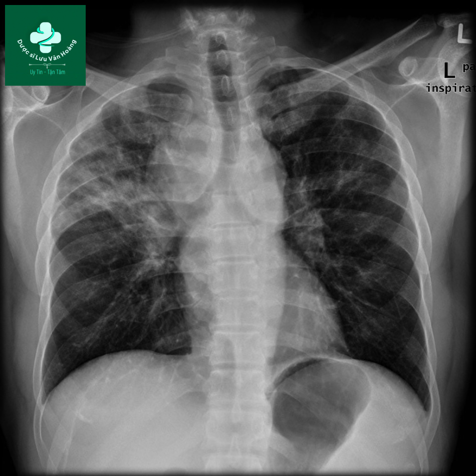 sarcoidosis 1