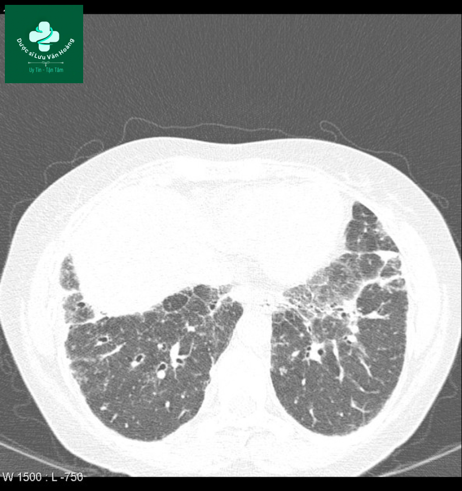 sarcoidosis 11