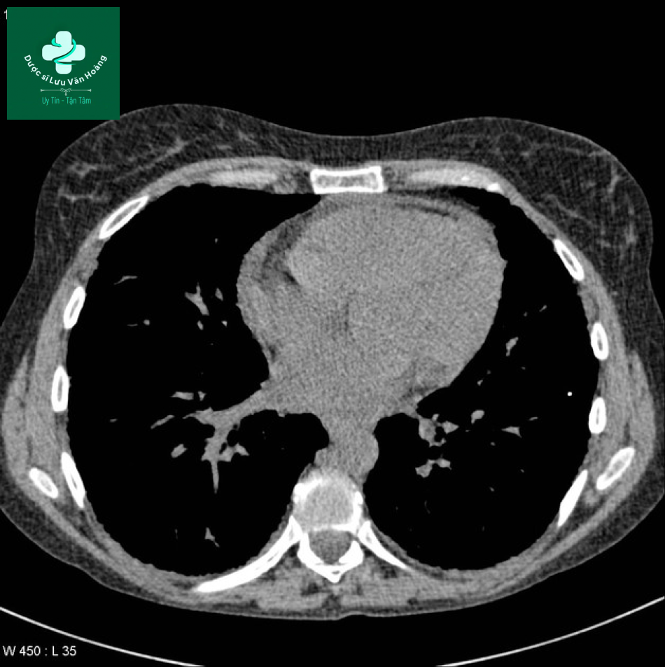sarcoidosis 13