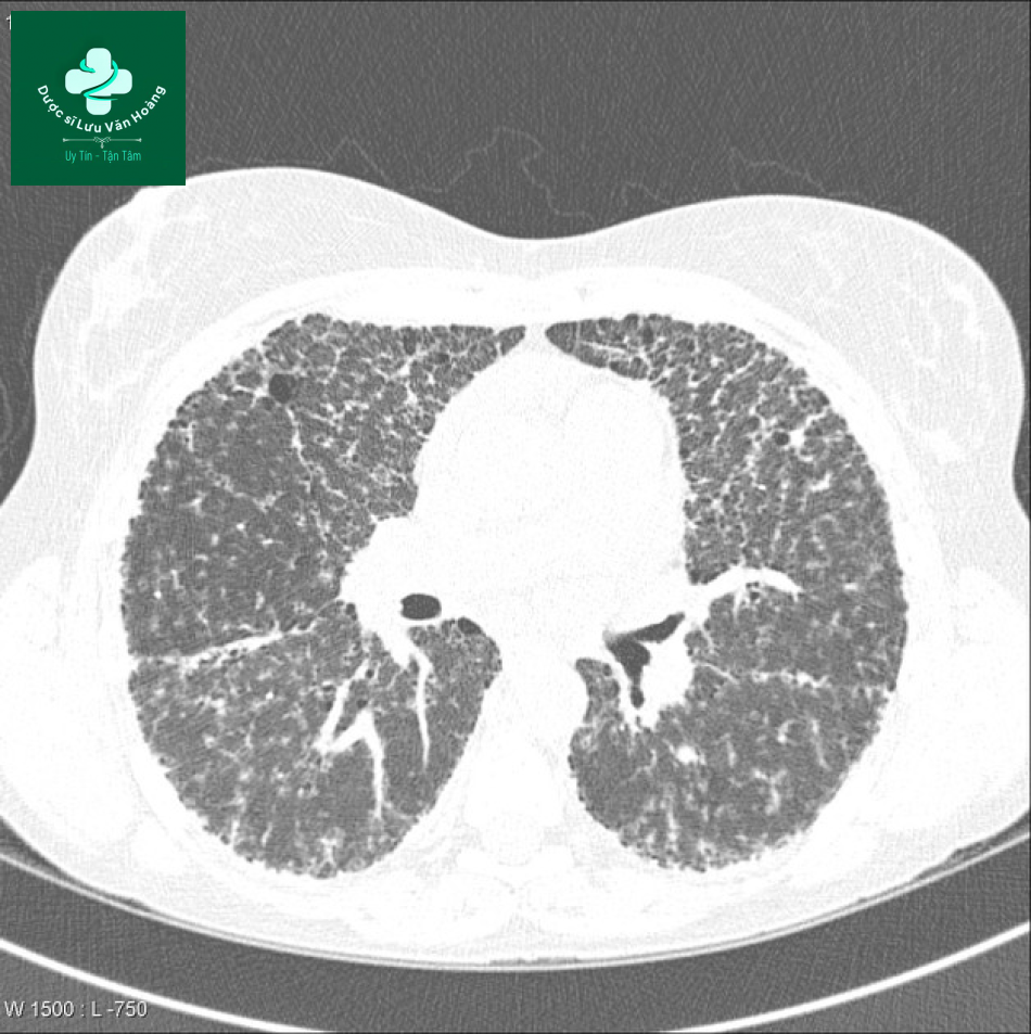 sarcoidosis 14