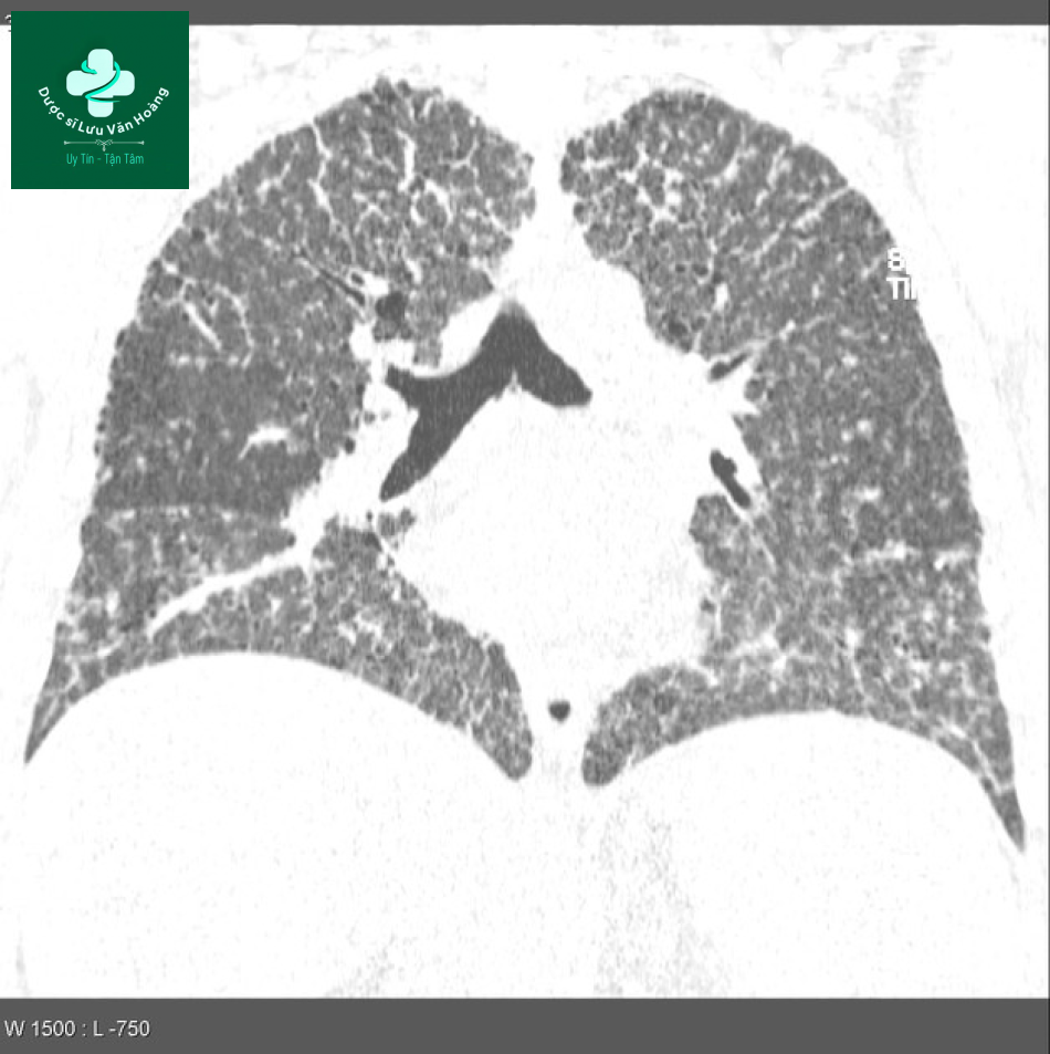 sarcoidosis 15