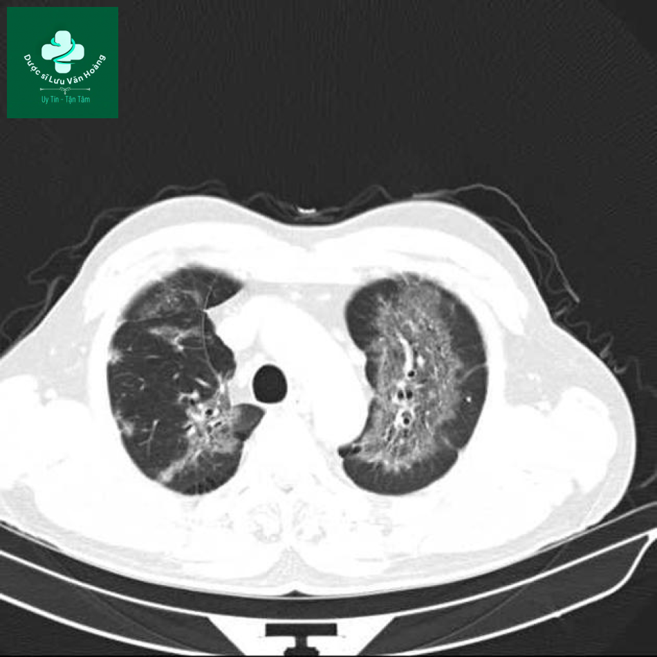 sarcoidosis 16