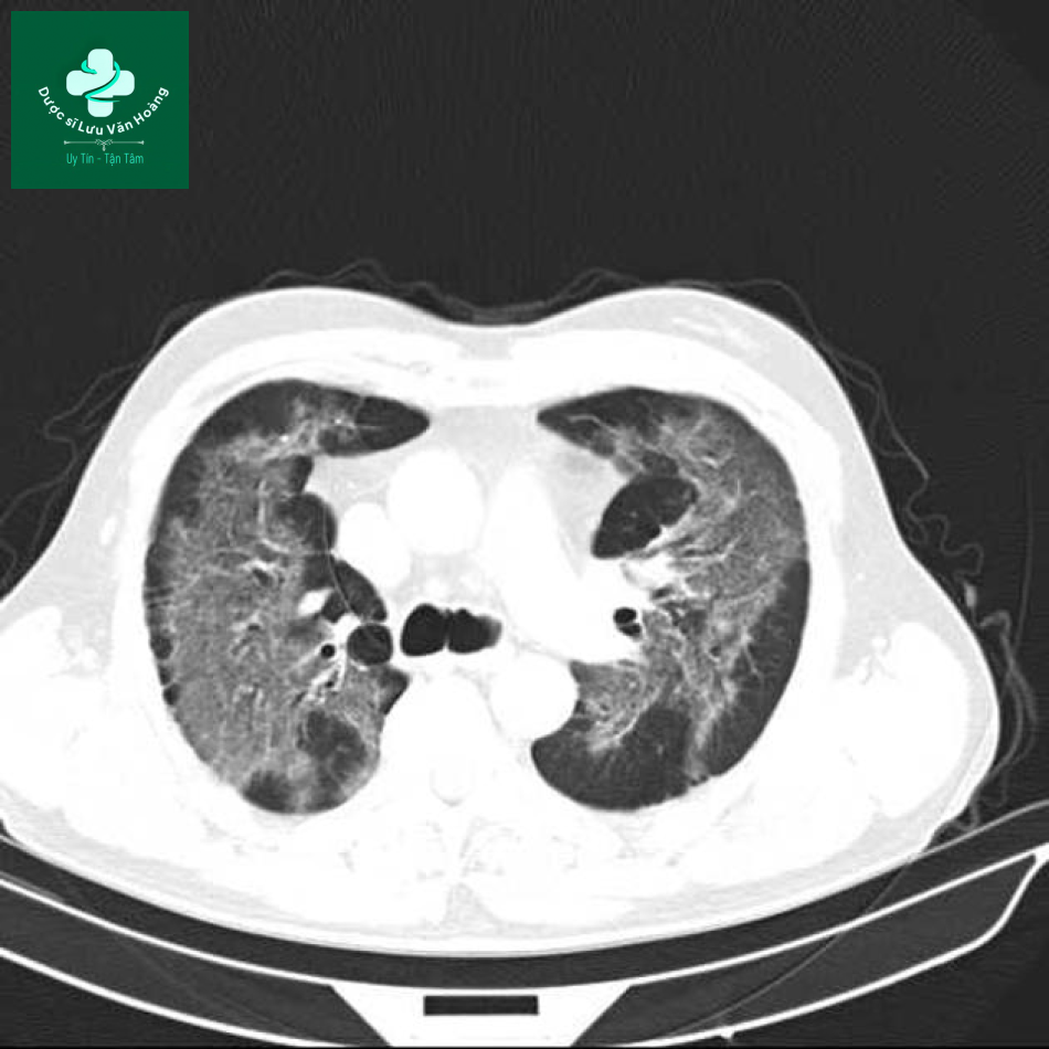 sarcoidosis 17