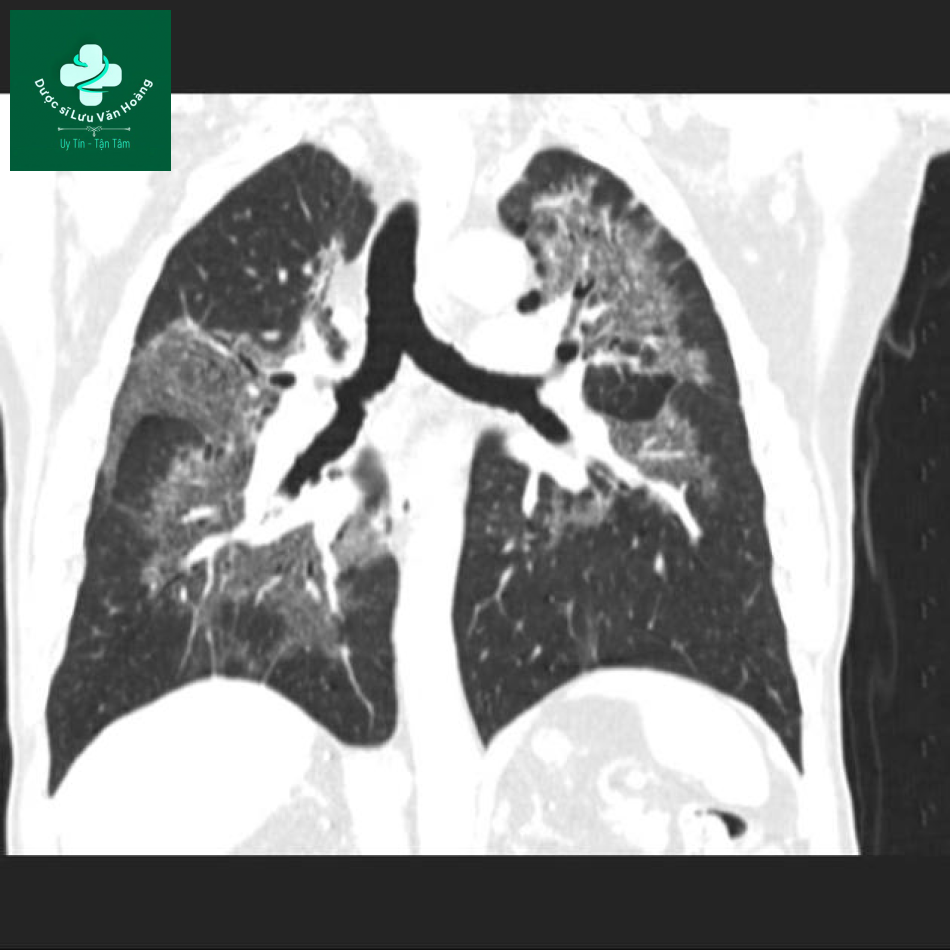sarcoidosis 18