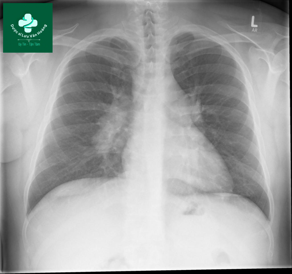 sarcoidosis 2