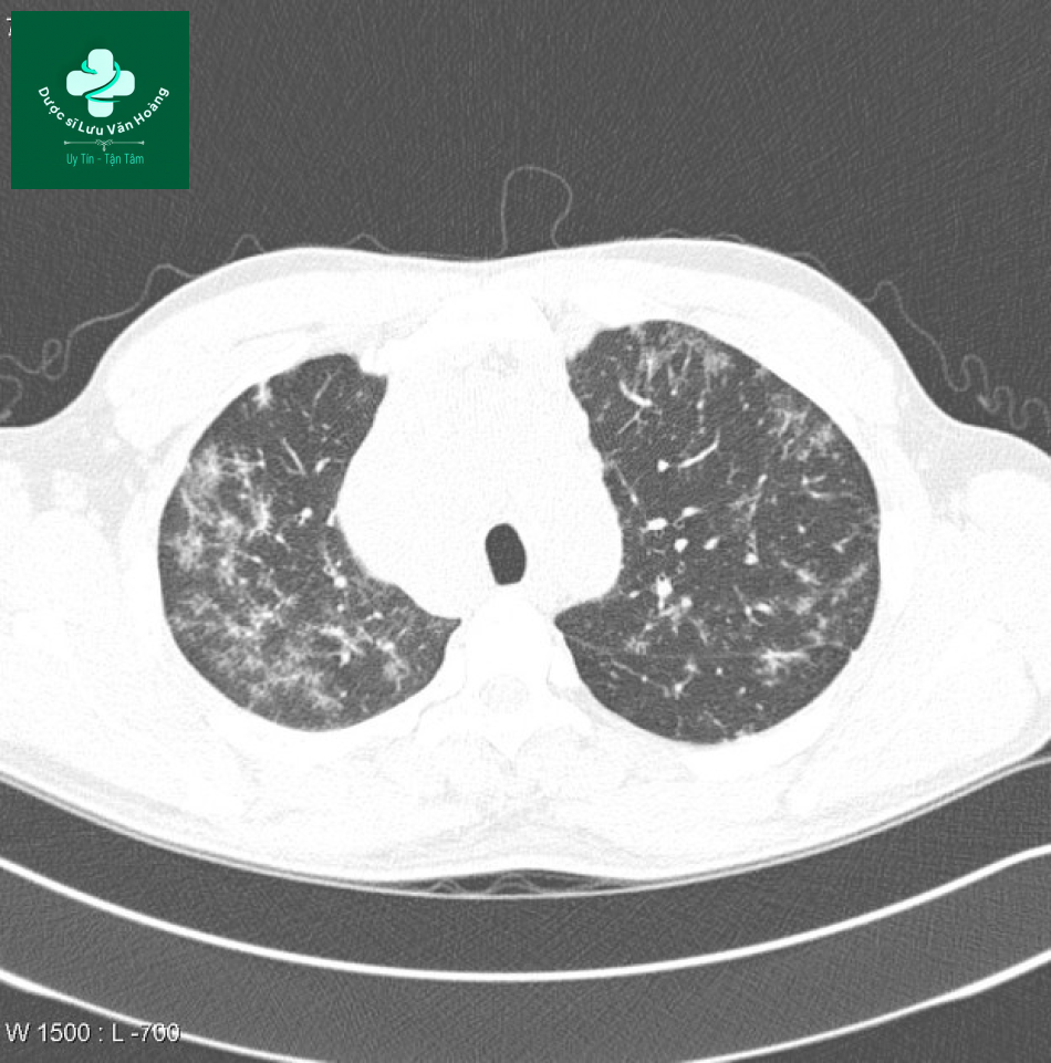 sarcoidosis 3