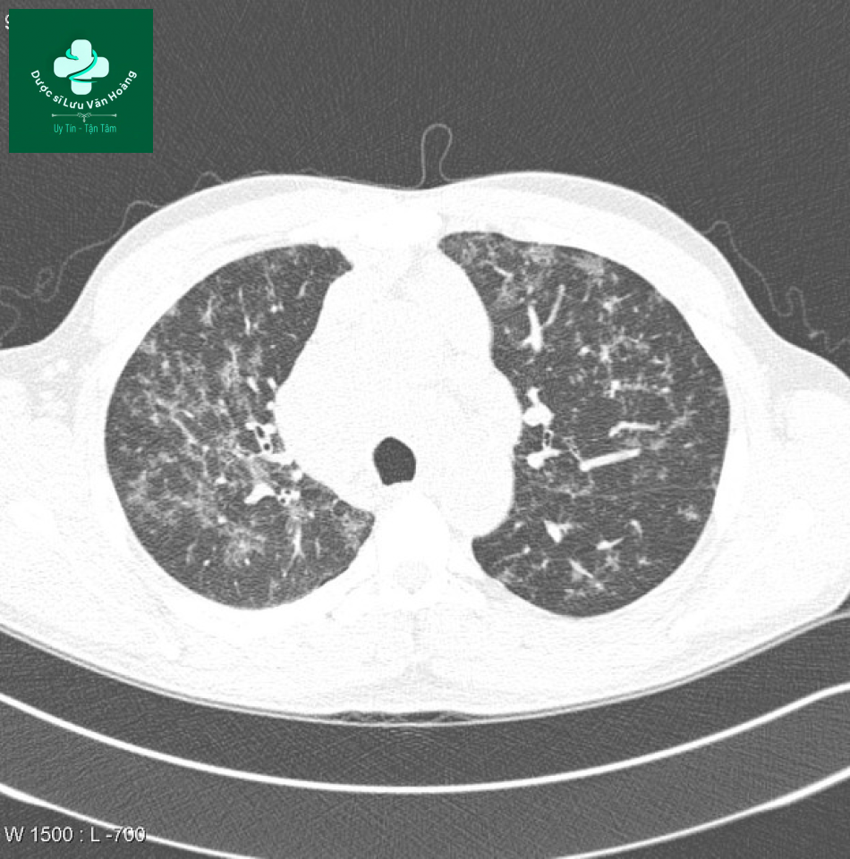 sarcoidosis 4