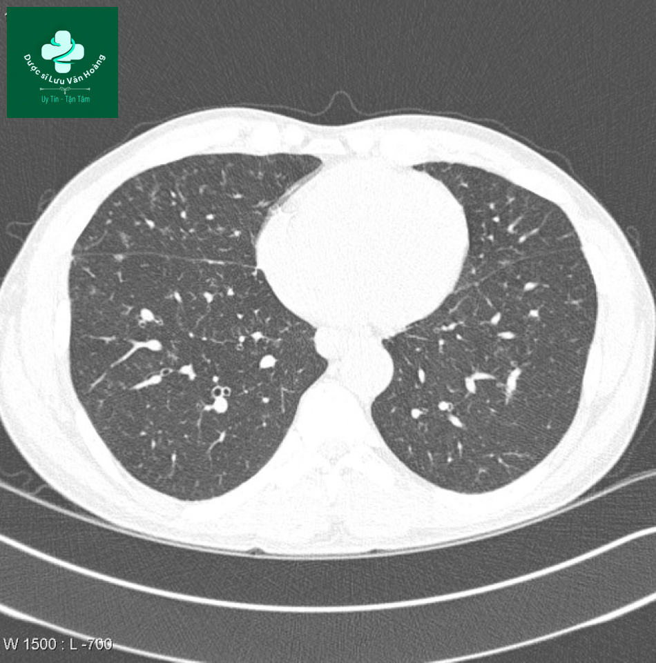 sarcoidosis 5
