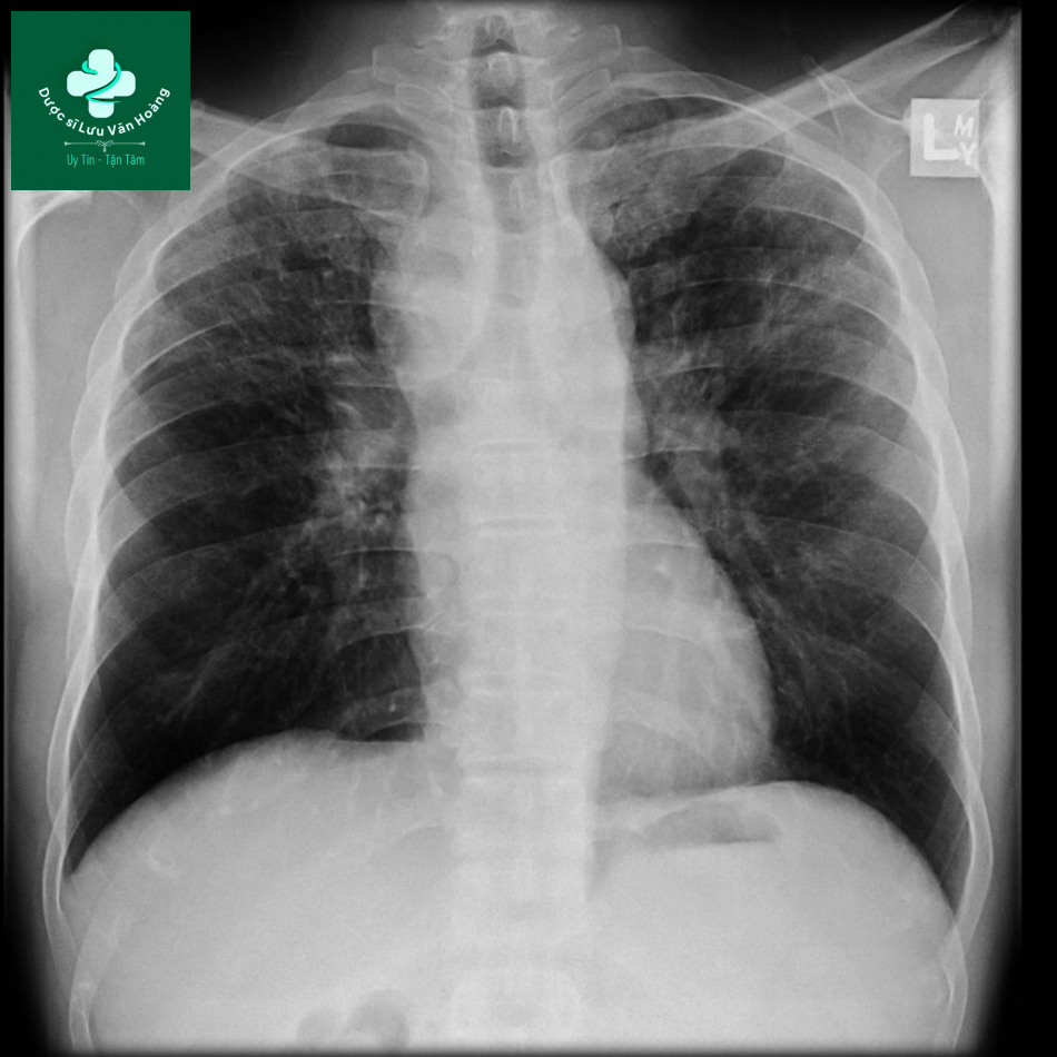 sarcoidosis 6