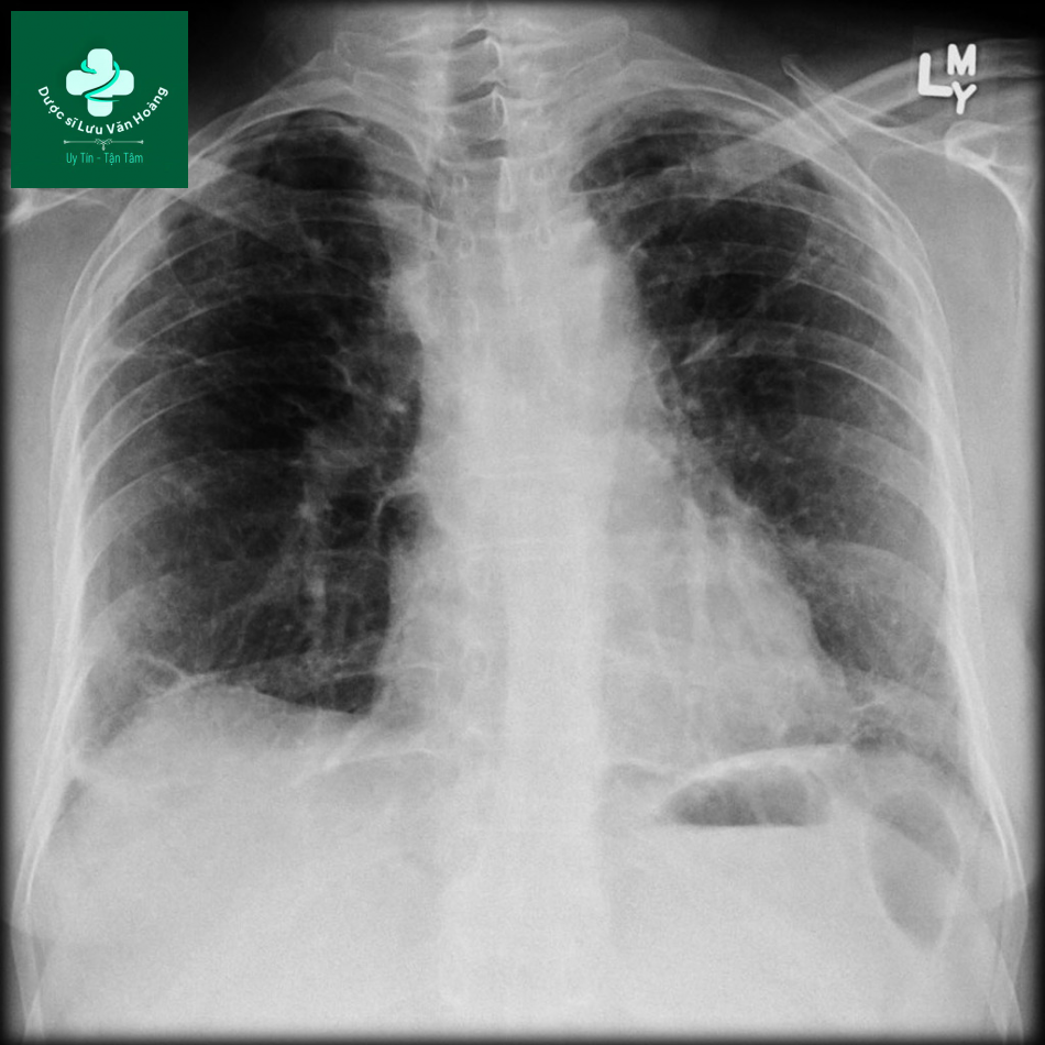sarcoidosis 7