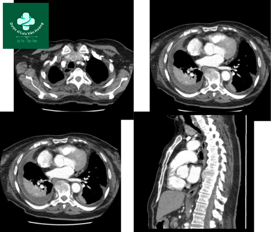 Follicular thyroid cancer 1