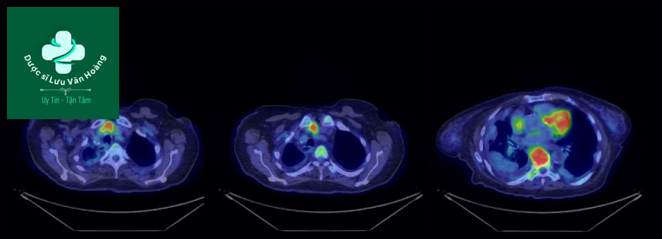 Follicular thyroid cancer 2