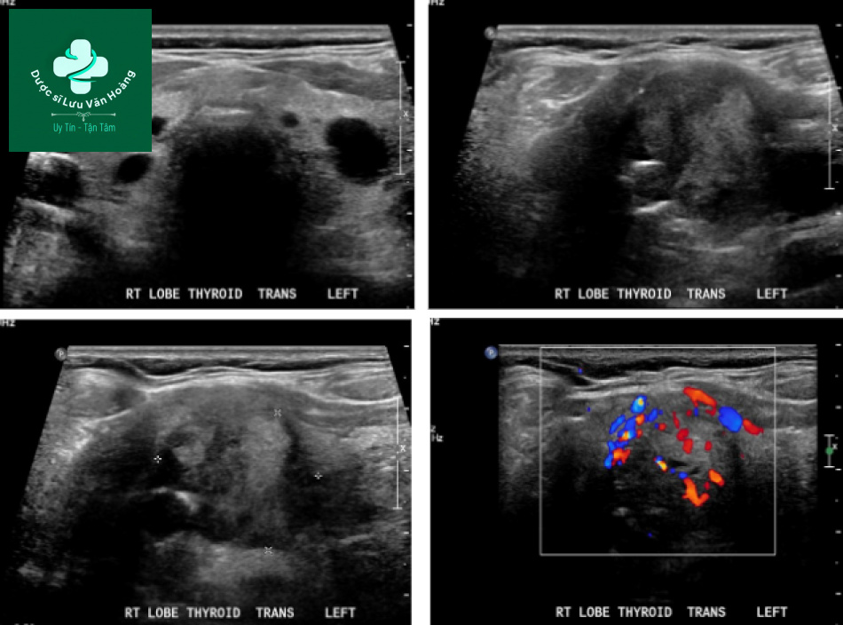 Follicular thyroid cancer 3