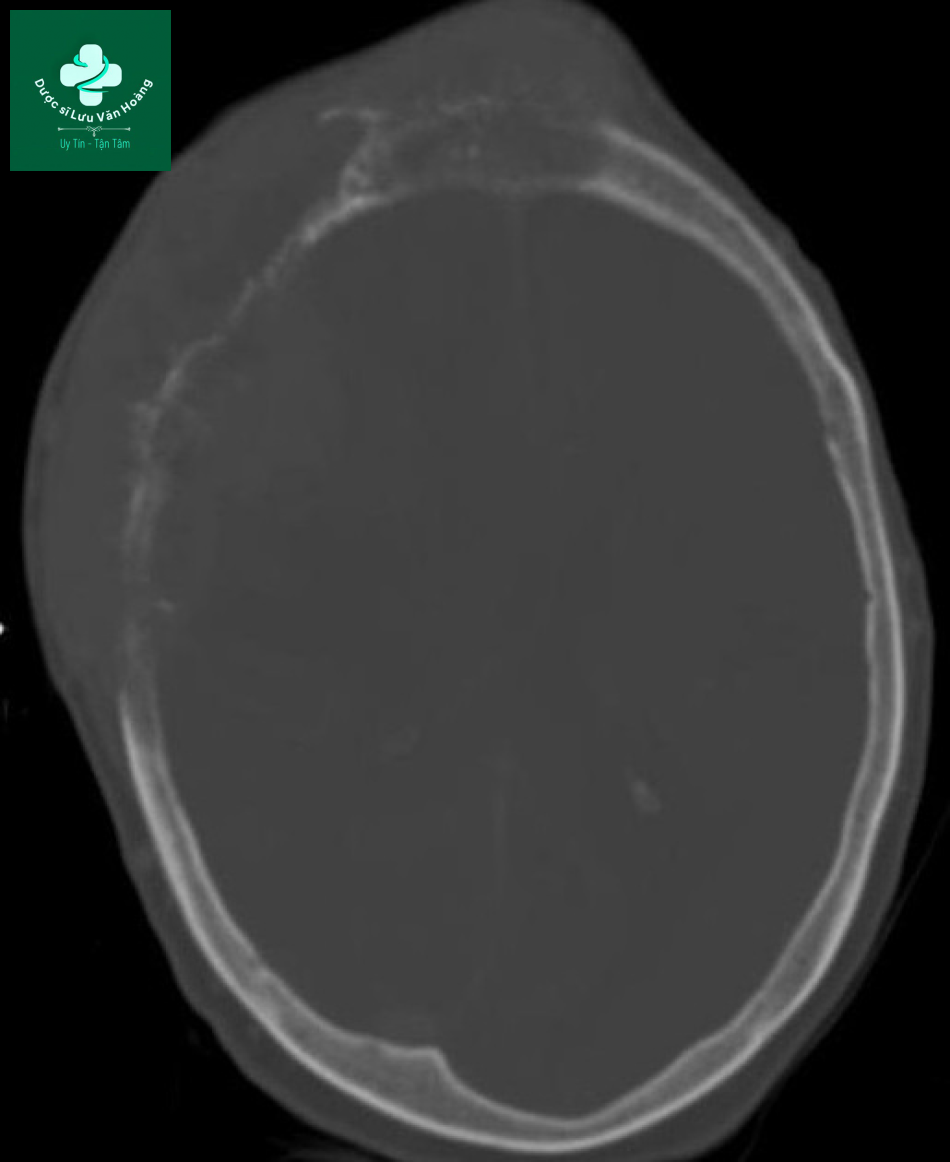 Follicular thyroid cancer 5