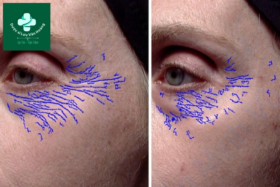 Hình 2. Hình ảnh khuôn mặt trước (a) và sau (b) để đánh giá hiệu quả sau khi dùng dược mỹ phẩm được thiết kế để giảm thiểu nếp nhăn nhỏ _ nếp nhăn bằng sử dụng phân tích hình ảnh kỹ thuật số.