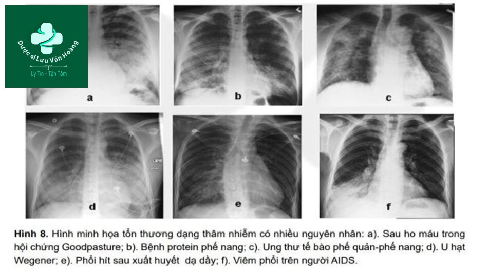 Xquang ngực và hình ảnh mờ không đặc hiệu 