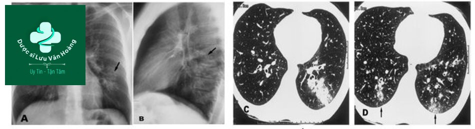 Tổn thương phân thùy đỉnh thùy dưới trái trên phim thẳng (A) và nghiêng trái (B) CT phát hiện thêm tổn thương dạng phế quản-phế viêm ở phổi phải và thùy dưới trái ( C, D).