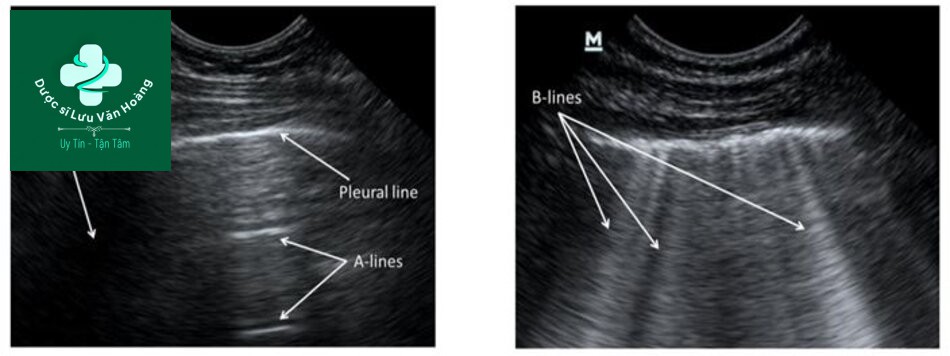 Trên siêu âm bình thường có thể thấy các đường: Đường A: Là các vệt tăng phản âm chạy song song với đường màng phổi mà bản chất là vệt phản âm của màng phổi. Đường B: Vệt sáng dạng đuôi sao chổi mà bản chất được cho là các thay đổi cấu trúc phổi giữa khí và dịch của khoảng kẽ tạo nên. Bình thường đường B có thể thấy ở phổi khỏe mạnh nhưng đường B tăng lên về số lượng và mật độ hoặc khi các đường B kết nối lại sẽ được xem là bệnh lý. 
