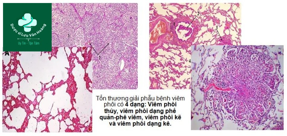 Tổn thương giải phẫu bệnh viêm phổi có 4 dạng: Viêm phổi thùy, viêm phổi dạng phế quản-phế viêm, viêm phổi kẽ và viêm phổi dạng kê. 