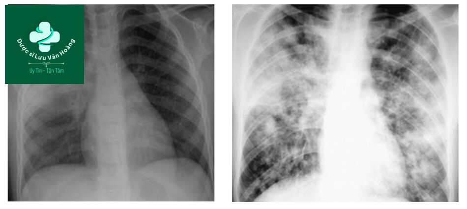 XQuang viêm phổi kẽ, viêm phổi dạng kê