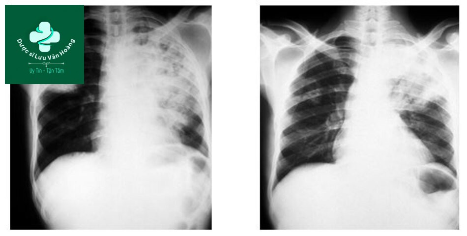 Đông đặc phổi đồng nhất và đông đặc phổi hoại tử
